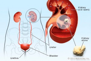 Kidney stone diagram