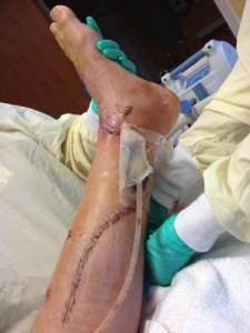 Ammon McNeely reconstructed leg, in the hospital before being released. Nov. 10, 2013 | Photo courtesy of Ammon McNeely, St. George News