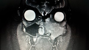 An X-ray image shows the tumor spreading from Nate Houle's maxillary sinus cavity, Photo courtesy of Kacee Houle, for St. George News