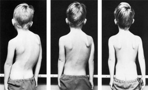  From left: Image 1, 5-year-old boy, scoliosis resulting from polio; image 2, after 3 weeks of intensive Schroth treatment; image 3, after 8 weeks of Schroth scoliosis exercise therapy| Photo courtesy of Schroth Method. St. George News | Click to enlarge image