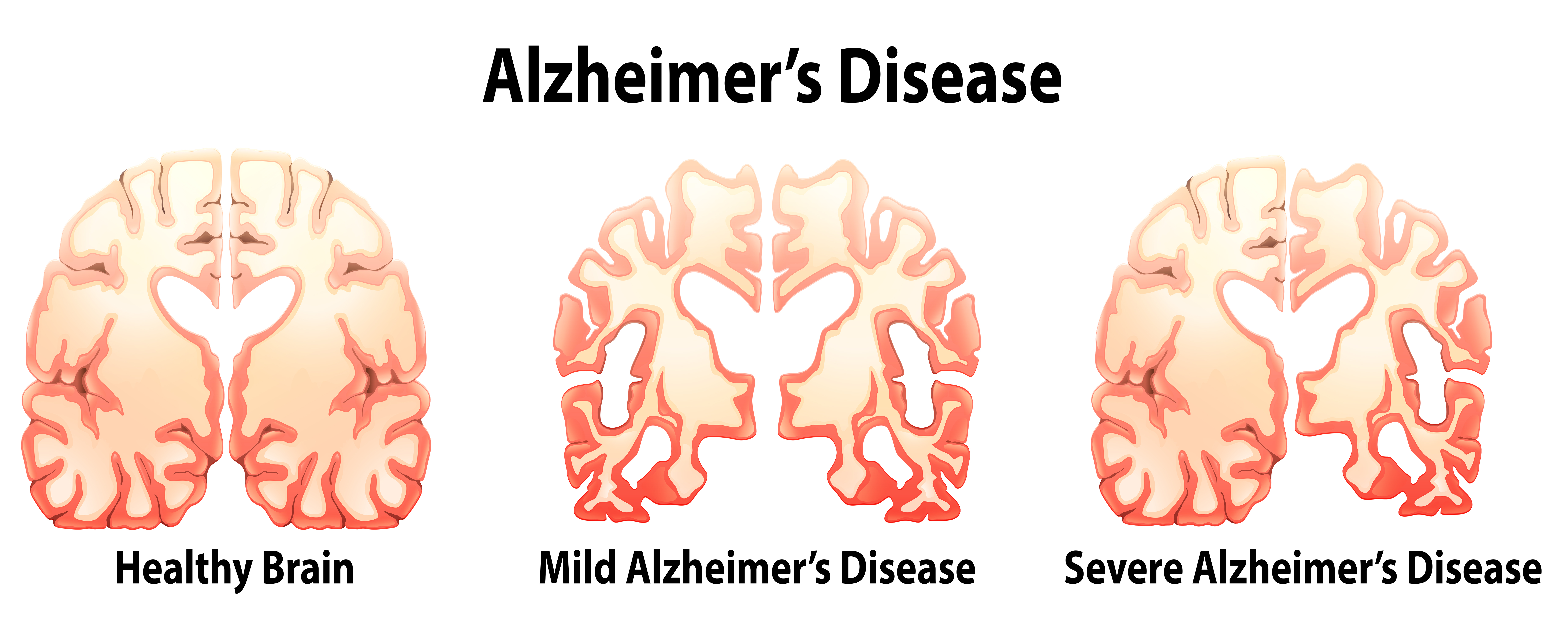 How Alzheimer Is A Disease That Affects