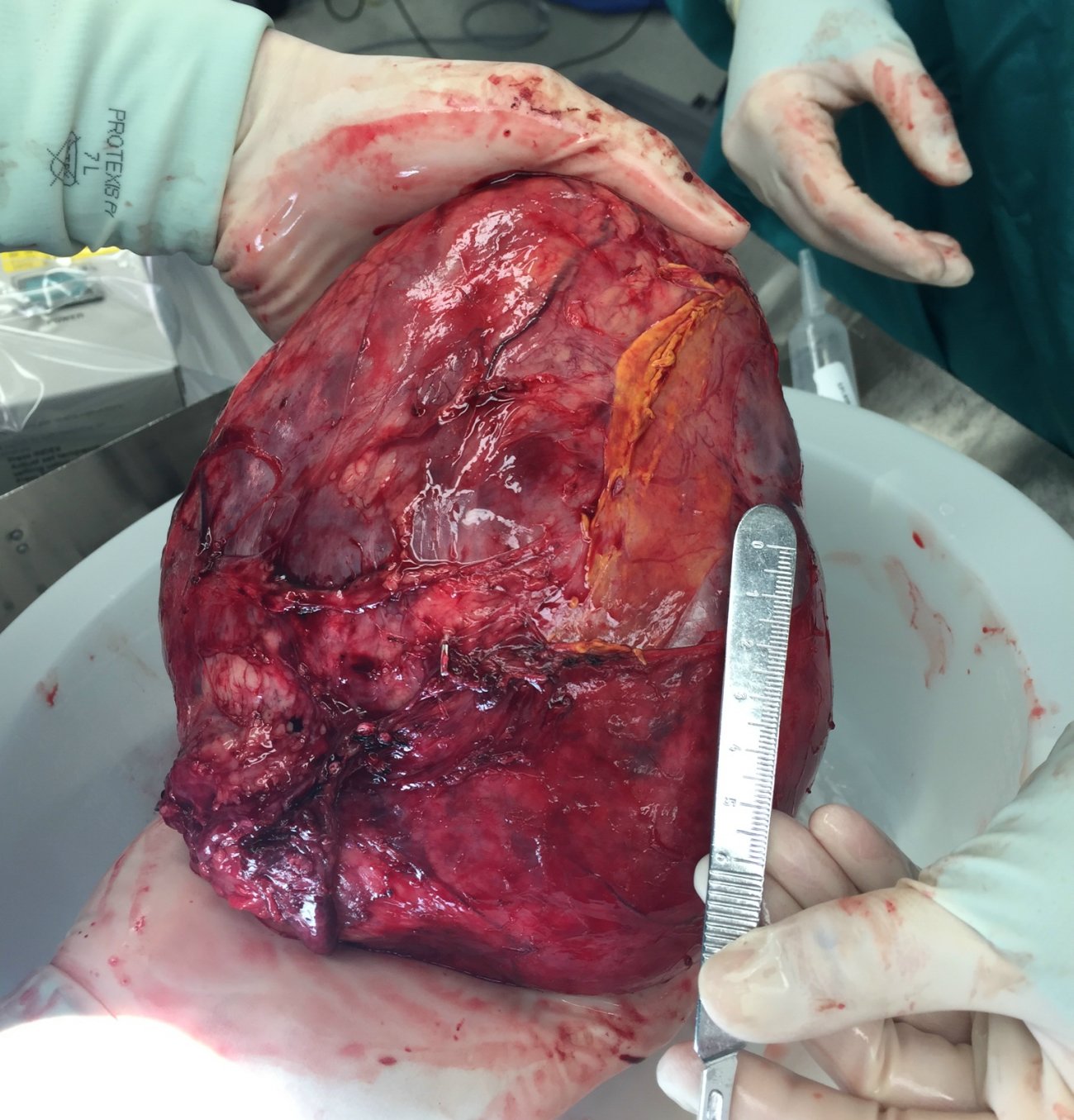 The Wilms' tumor that was taken out of George Stafford, St. George/Salt Lake City, Utah, Circa 2014-15 | Photo courtesy of Travis and Jen Stafford, St. George News