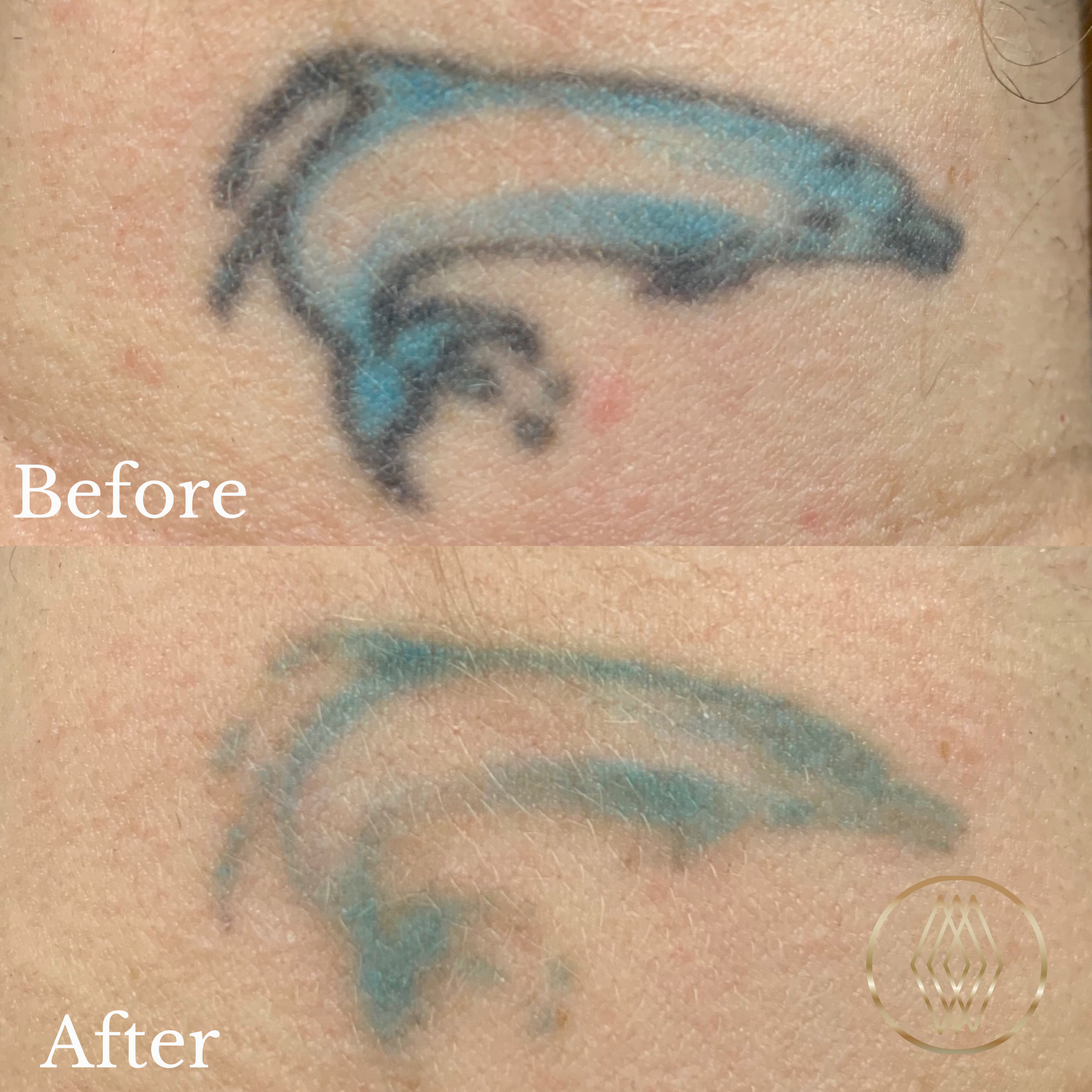 TATTOO REMOVAL  cleanskinlaser