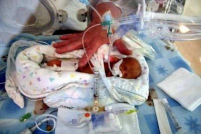 Corbin Kirkham is seen in the NICU after he is born weighing one pound and seven ounces, location and date unspecified | Photo courtesy of Stacy Mitchell, St. George News